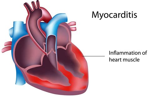 o que é miocardite